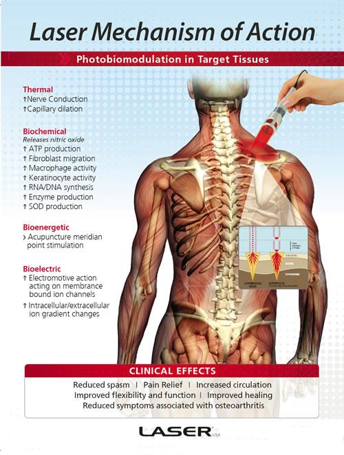 Laser Therapy