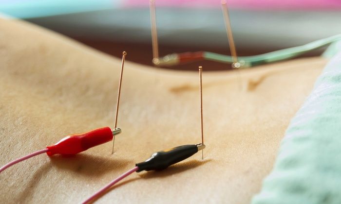 Dry Needling